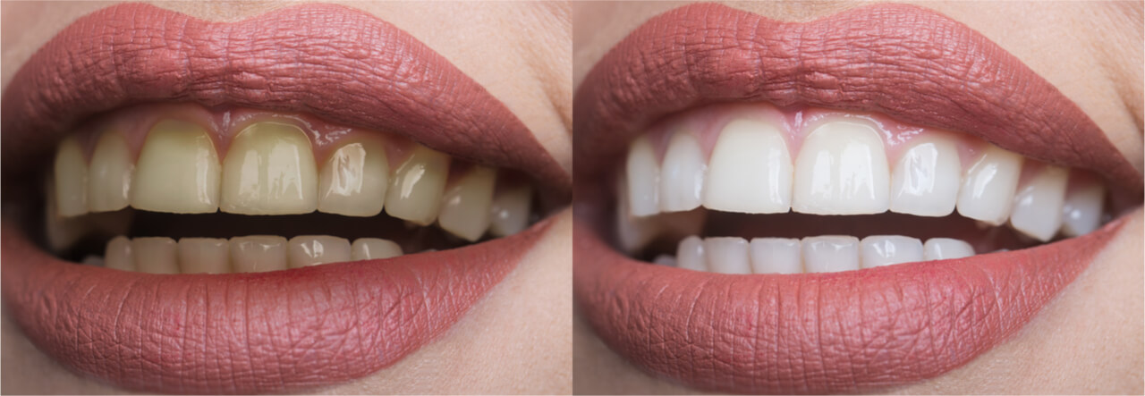 cosmetic dentistry, before and afters images