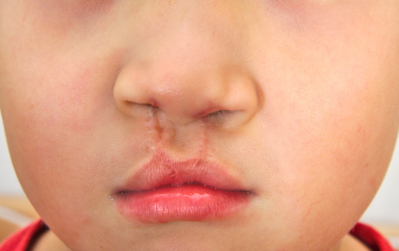 cleft lip surgery