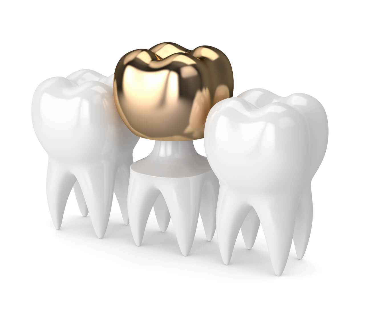 gold crown tooth