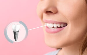 dental implant surgery recovery results